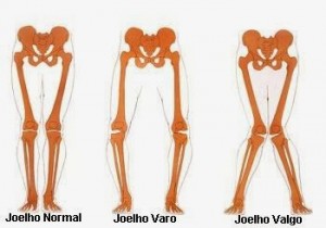 tipos-joelhos geno varo-síndrome do trato ou banda iliotibial